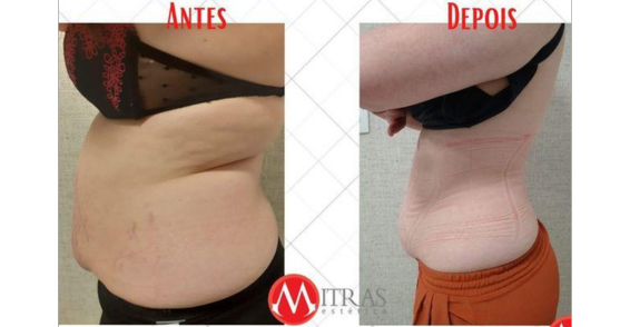 Criolipolise de Placas