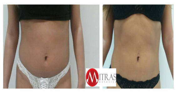 Criolipólise Vila Mariana